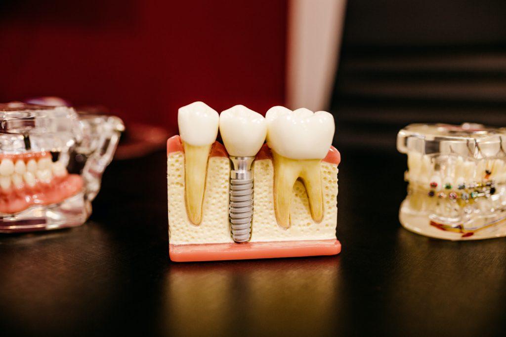 Things You Should Know About Dental Insurance
