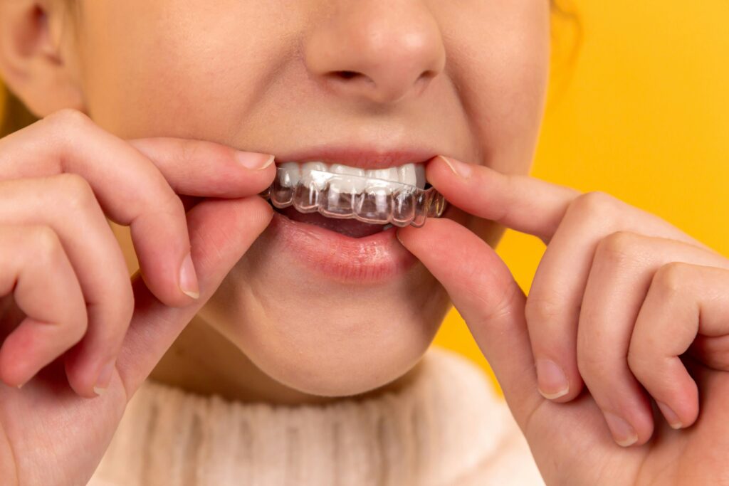 Clear Aligners: What They're Made of and Why It Matters