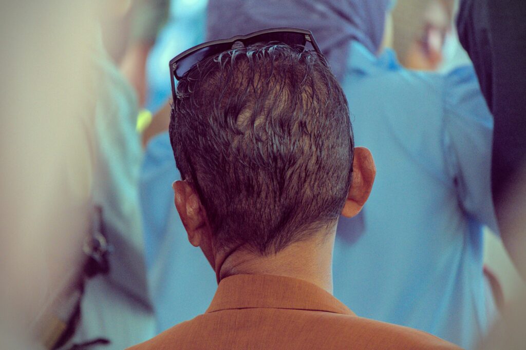 How To Choose The Right Hair Transplant Clinic in Liverpool
